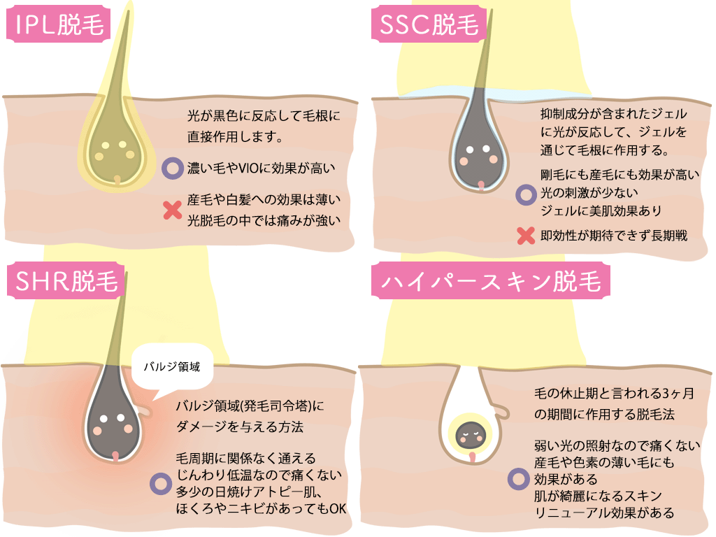 Shr脱毛とは 効果や回数 痛みなど メリット デメリットを徹底解説 Motehada