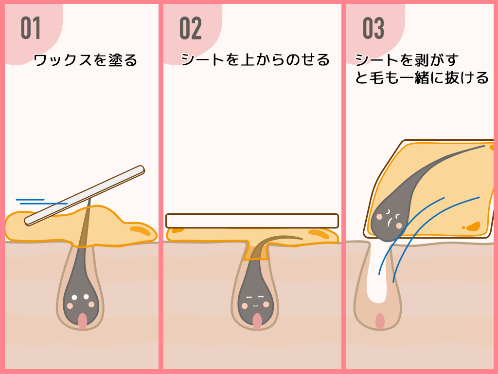 ブラジリアンワックス脱毛とは？効果や自宅での使い方など【メリット